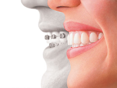 The image features a split-screen comparison between a person s natural smile and an enhanced smile with braces, highlighting the difference in appearance.